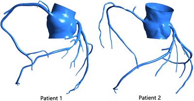 The Hemodynamic Mechanism of FFR-Guided Coronary Artery Bypass Grafting